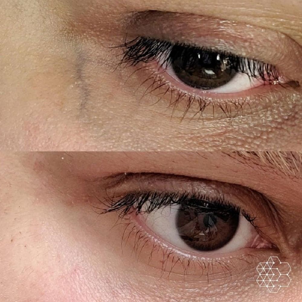PRF Under Eyes: A Clear, Honest Guide to Benefits, Safety, and Real Results prf under eyes