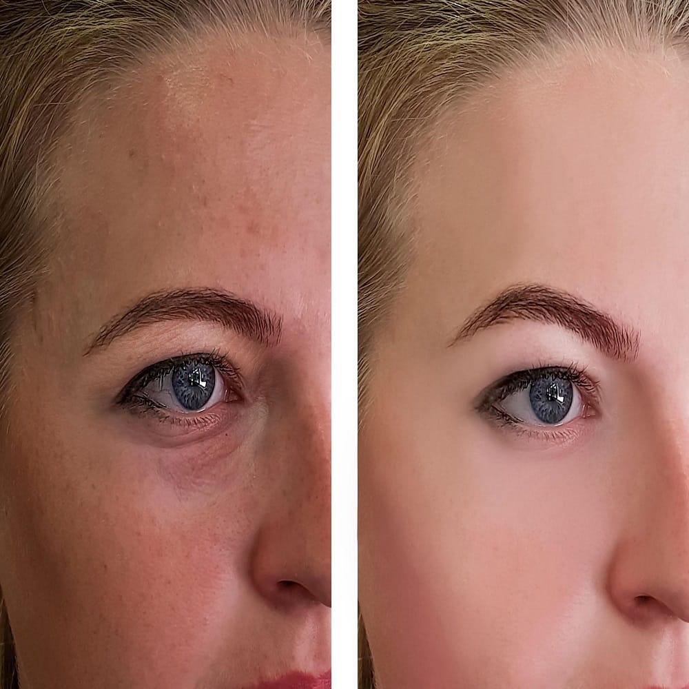 PRF Under Eyes: A Clear, Honest Guide to Benefits, Safety, and Real Results prf under eyes